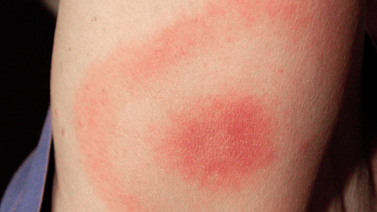Wanderröte im frühen Stadium der Borreliose – Erythema migrans am Arm als ringförmige Rötung mit dunklerem Zentrum